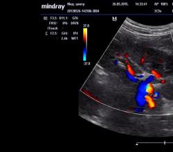 Как подготовиться к УЗИ почечных артерий, сосудов и дуплексному сканированию почек с ЦДК?